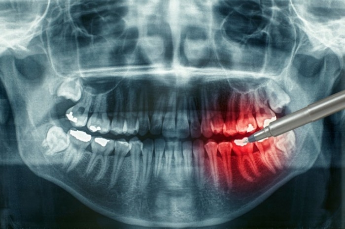 Визуализация наноструктуры зуба: новый метод рентгеновской съемки