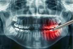 Визуализация наноструктуры зуба: новый метод рентгеновской съемки